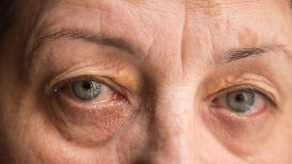 眼睛反复发炎红肿怎么办 眼睛发炎可以吃双黄连口服液吗