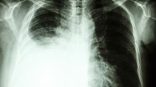 慢性肺病五年补肺成了“必修课”  新冠咳嗽能吃补肺丸吗