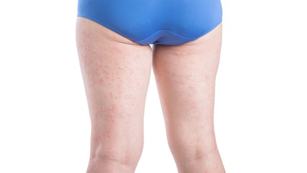 大腿根部有红斑怀疑是生殖器疱疹早期症状