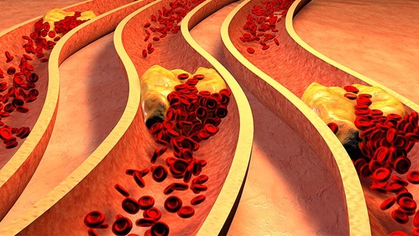 肠激综合征会导致缺铁性贫血吗