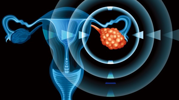 宫颈癌的中药辨证治疗
