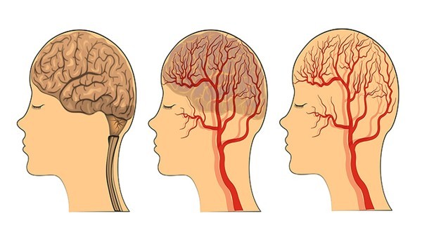 腦血管病頭暈頭疼能吃小柴胡顆粒嗎,[心腦血管病]頭暈頭痛怎么治療