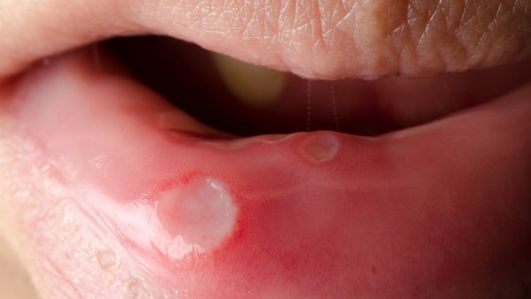 口炎颗粒的用法及用量是什么 口炎颗粒是抗病毒的药吗