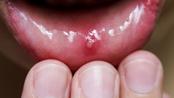 口炎清片成人吃多少 口腔炎症导致口臭吃什么药