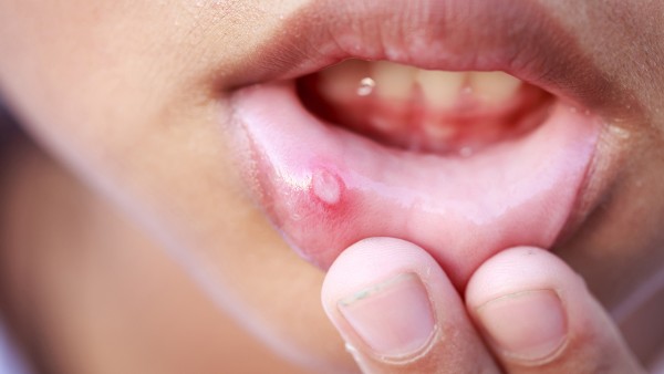 口炎清片效果好吗?口腔炎症导致口臭吃什么药
