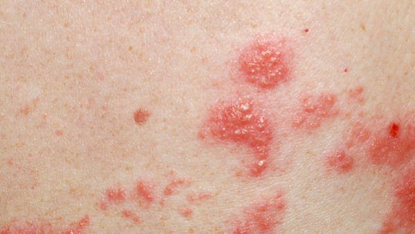 治艾滋病的药能治新冠肺炎吗  治疗新冠的药物有哪些