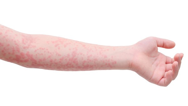秋季荨麻疹用什么药治疗效果比较好  化毒丹效果好吗