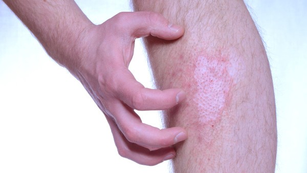 皮肤病用药的原则 治皮肤病的药