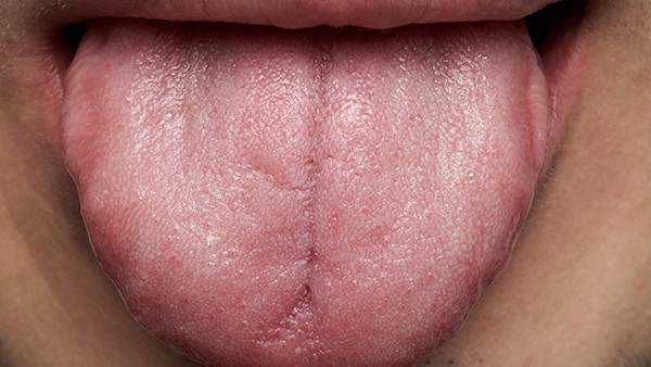 舌头出血是怎么回事 舌疮可以喝双黄连口服液吗