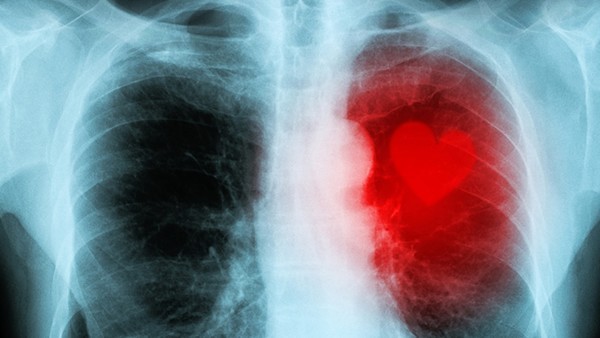 肺癌咳嗽厉害吃什么药 磷酸苯丙哌林胶囊和益肺止咳胶囊能一起吃吗