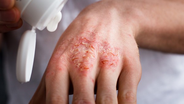 皮肤病血毒丸的功效作用有什么呢?
