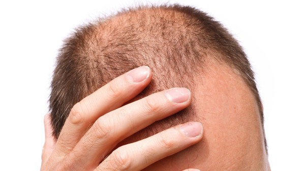 服用固肾生发丸治疗斑秃作用效果好吗?