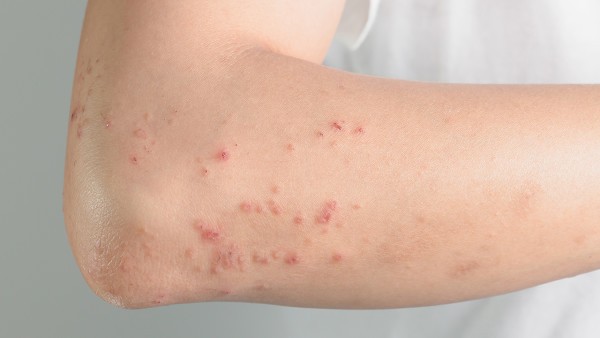 慢性荨麻疹服用消风止痒颗粒有没有效果?