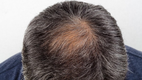 米诺地尔酊治疗脱发的疗效体现是什么？