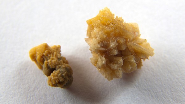 心梗假如不疼危害更大 轻微心梗的症状有哪些