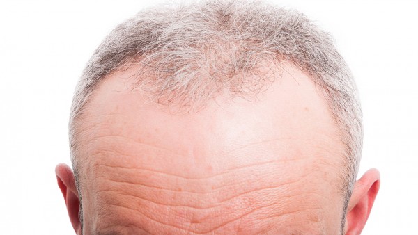 头发白癣多久能好,如何预防和治疗头癣?