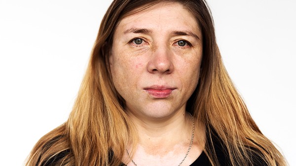 有黄褐斑吃什么食物 黄褐斑慎食哪几种食物