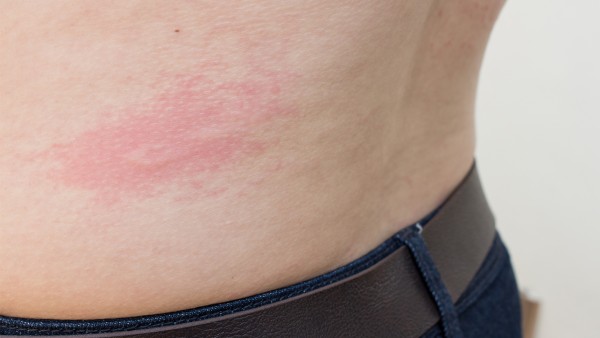 妥布霉素地塞米松眼膏的用法用量是多少？