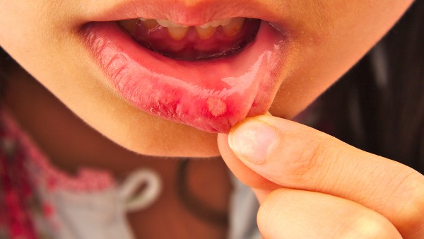 复方氯己定地塞米松膜的用法用量是多少？