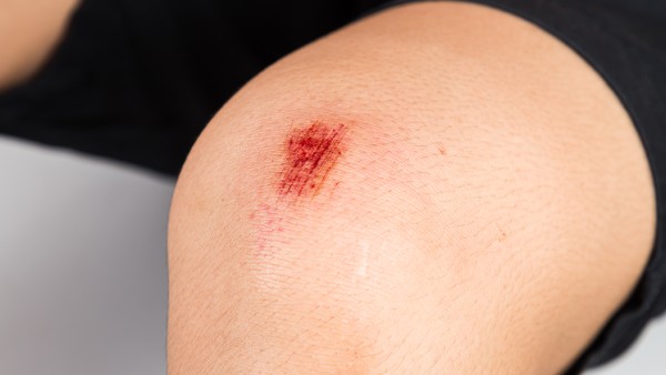 有什么可以消除疤痕的药膏，有没有什么祛疤痕的药膏比较有效