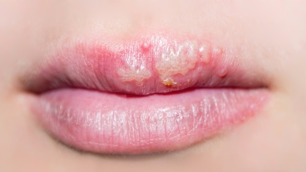 阿昔洛韋分散片用法用量是怎樣的?