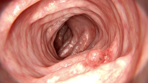 蒙脱石散用法用量是什么？蒙脱石散的用法及用量说明