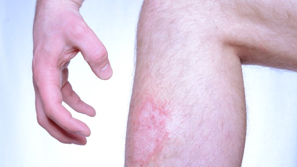 復方青黛丸治療銀屑病效果如何 復方青黛丸與連花清瘟膠囊可以一起吃嗎