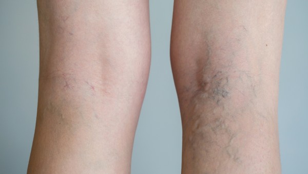 痛風(fēng)能吃蒜苗嗎 痛風(fēng)定膠囊與連花清瘟膠囊可以一起吃嗎