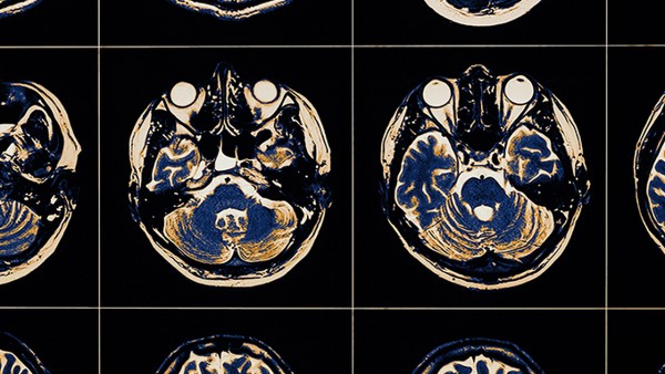 压氏达苯磺酸氨氯地平片价格多少钱 苯磺酸氨氯地平片用法用量