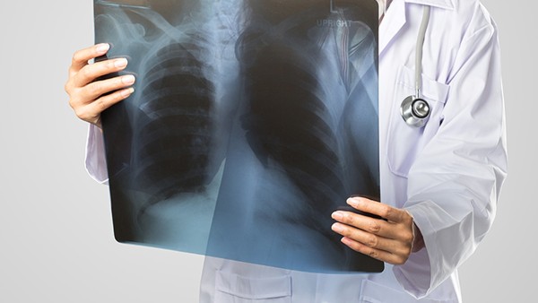 新冠咳嗽严重怎么办 新亚复方氢溴酸右美沙芬颗粒可以治疗新冠肺炎吗