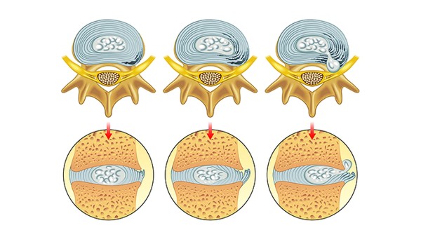 感染新冠后该如何治疗好 新型冠状病毒肺炎治疗方案