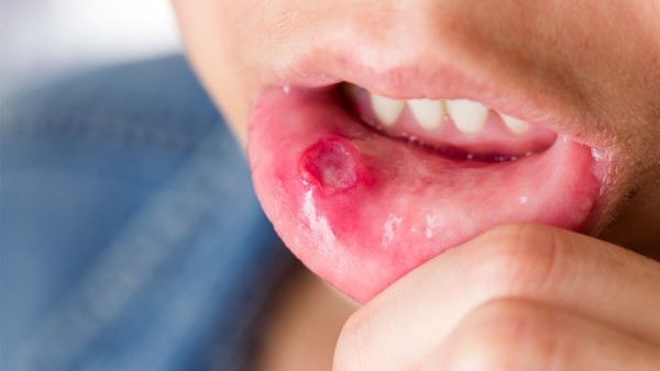 复方百部止咳糖浆能和维c银翘片一起吃吗 口腔溃疡吃维C银翘片有用吗？