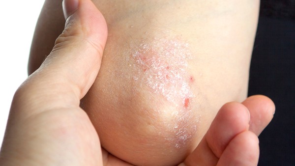 治疗关节病型牛皮癣的药物