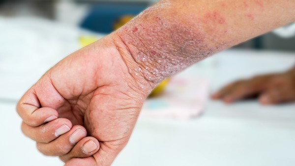 盐酸左西替利嗪片能和抗病毒口服液一起吃吗 盐酸西替利嗪片和通窍鼻炎片能一起吃吗