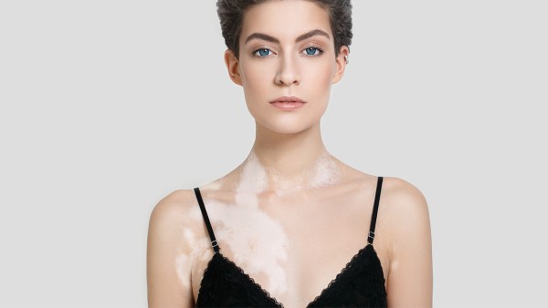 祛白酊治疗白癜风疗效怎么样？