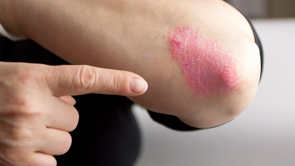 郁金银屑片治疗银屑病效果怎么样 郁金银屑片是抗病毒的药吗