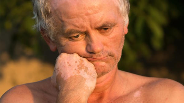 萘丁美酮分散片对皮肤的副作用有哪些呢？