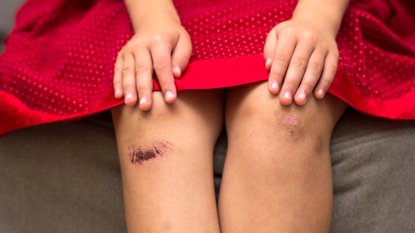 美洛昔康胶囊可以用于治疗类风湿性关节炎吗？