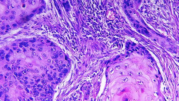 托吡酯片的功效 托吡酯片真的有效吗?